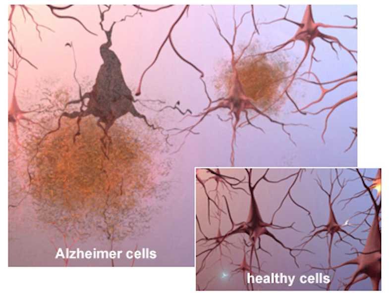 alzheimers-brain-cells-and-plaques